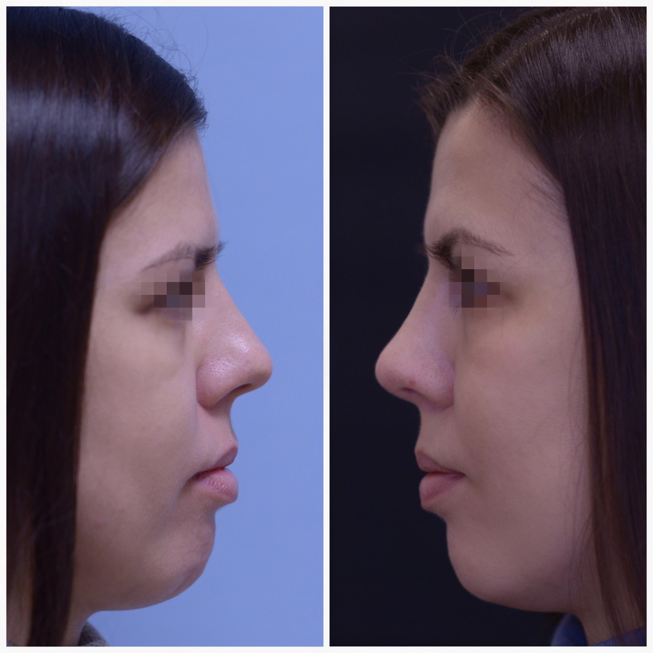 Операция по улучшению эстетики носа